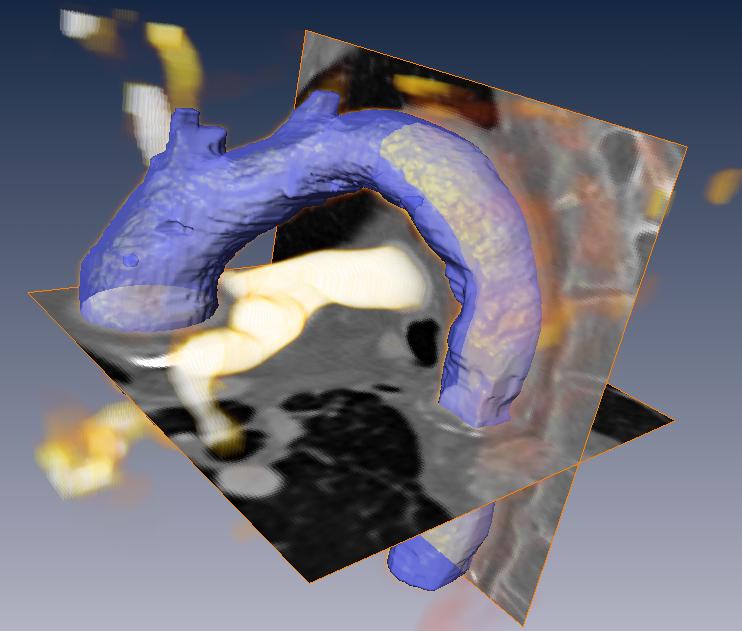 Aorta segmentation